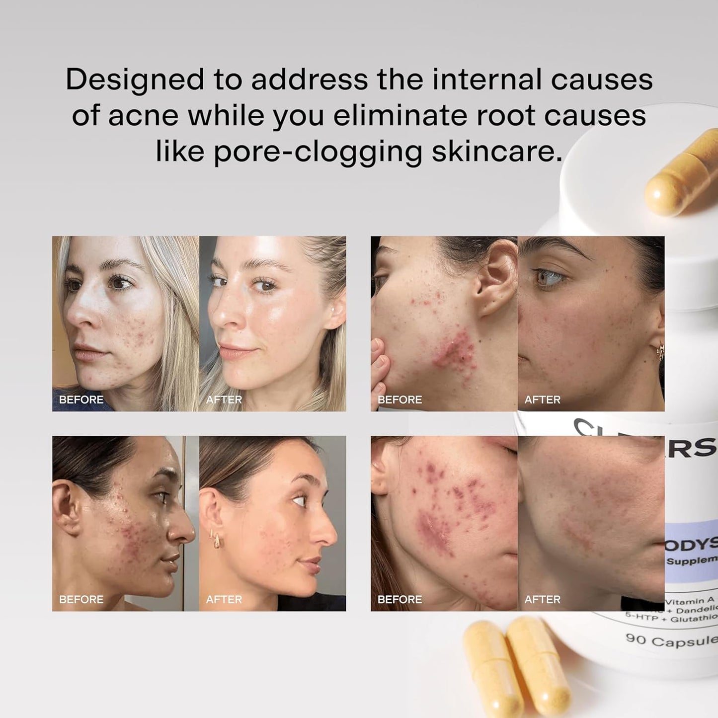 Elvera-CLEARSTEM Acne Solution